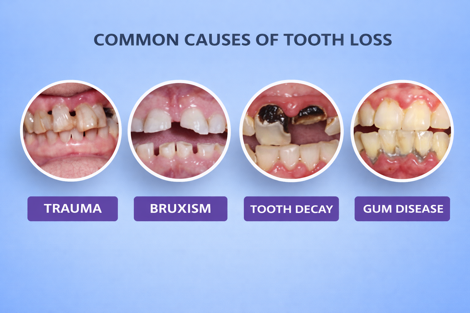 Effects of tea and coffee on teeth